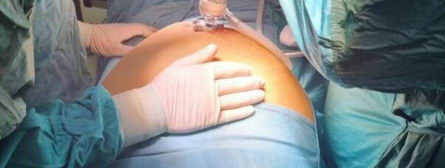 napoli primo intervento cardarelli dialisi peritoneale